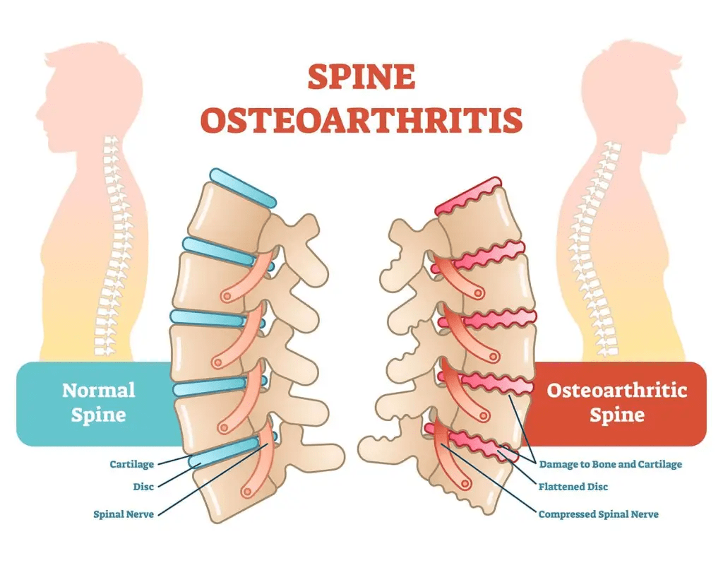 back pain